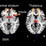 CBD effect on psychosis
